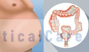 Что такое метеоризм и газы у взрослого: деликатная проблема и пути ее решения