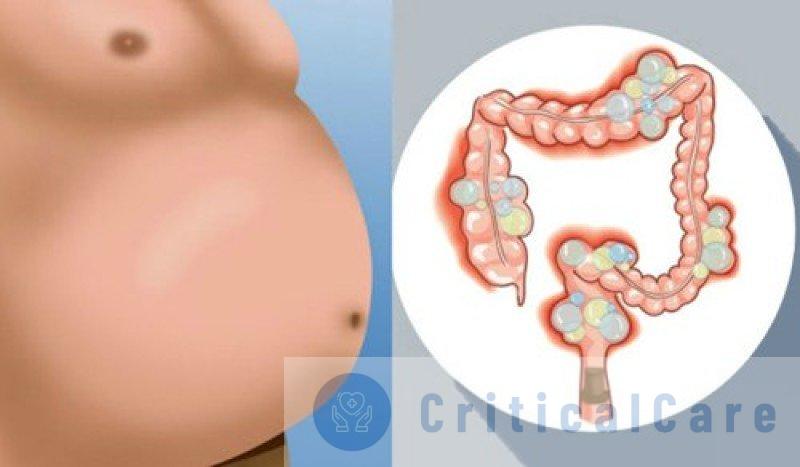 Что такое метеоризм и газы у взрослого: деликатная проблема и пути ее решения